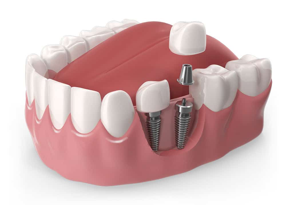 Secțiune transversală a unui implant dentar — diagramă explicativă