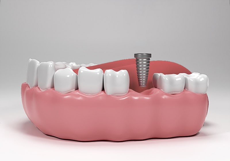 Proces clinic pentru implantul dentar - radacina artificiala
